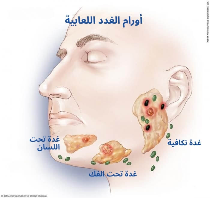 أورام الغدد اللعابية
