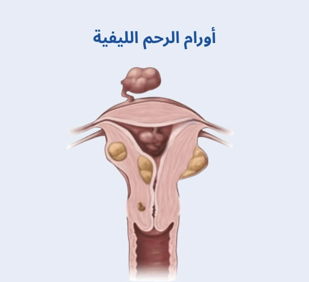 أورام الرحم الليفية