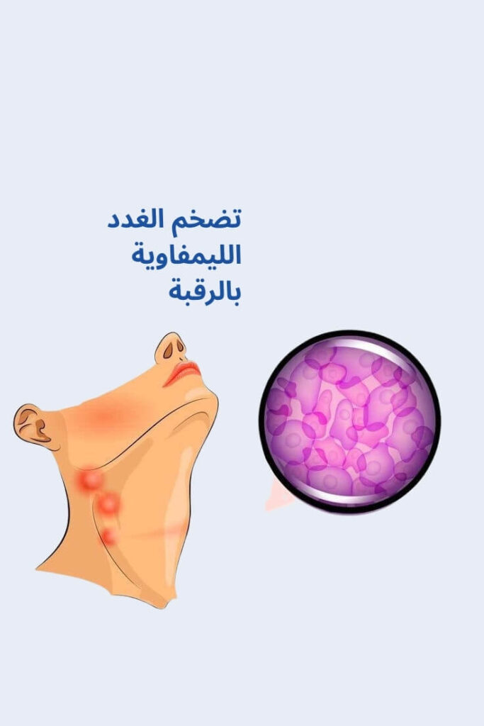 تضخم الغدد الليمفاوية بالرقبة