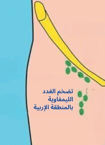 تضخم الغدد الليمفاوية بالمنطقة الإربية