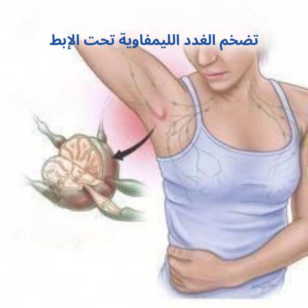 تضخم الغدد الليمفاوية تحت الإبط