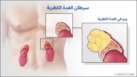 سرطان الغدة الكظرية