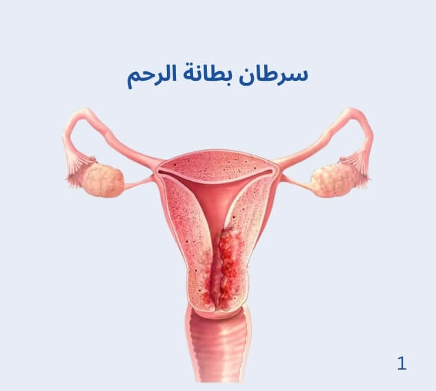 سرطان بطانة الرحم