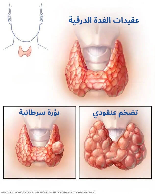 عقيدات الغدة الدرقية