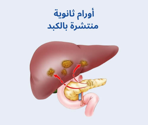 أورام ثانوية منتشرة بالكبد 