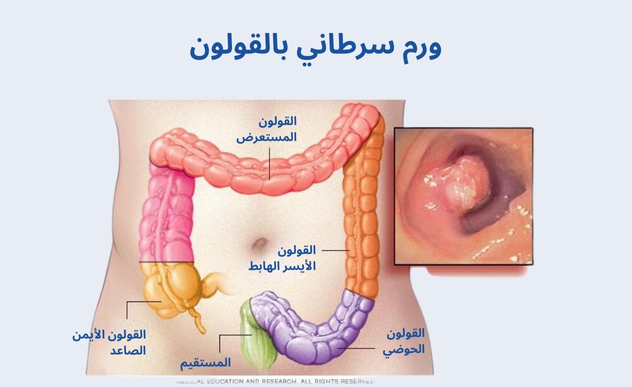 ورم سرطاني بالقولون