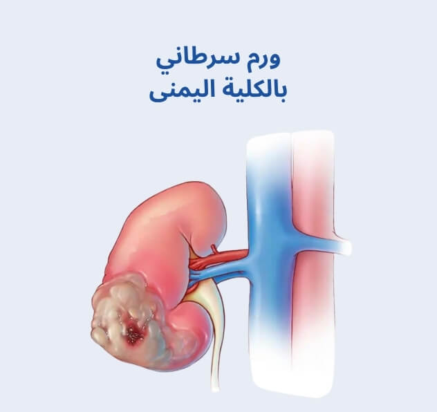 ورم سرطاني بالكلية اليمنى