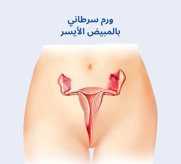 ورم سرطاني بالمبيض الأيسر
