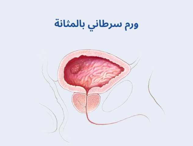 ورم سرطاني بالمثانة