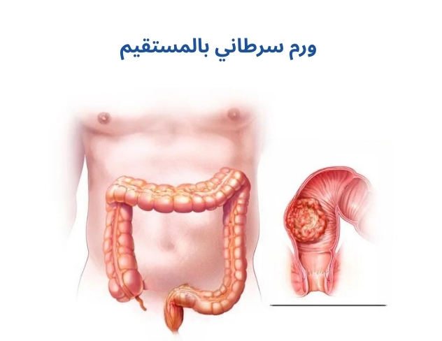 ورم سرطاني بالمستقيم