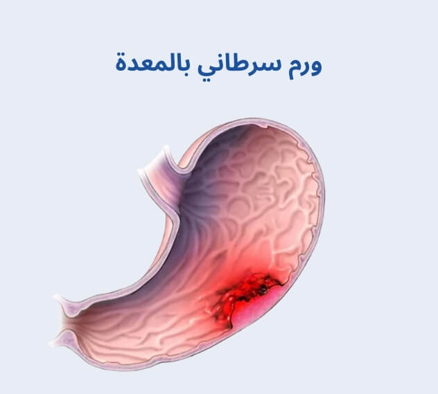ورم سرطاني بالمعدة