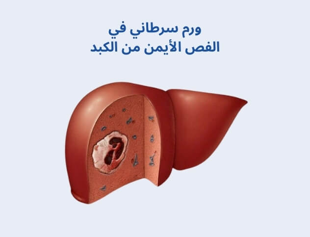 ورم سرطاني في الفص الأيمن من الكبد