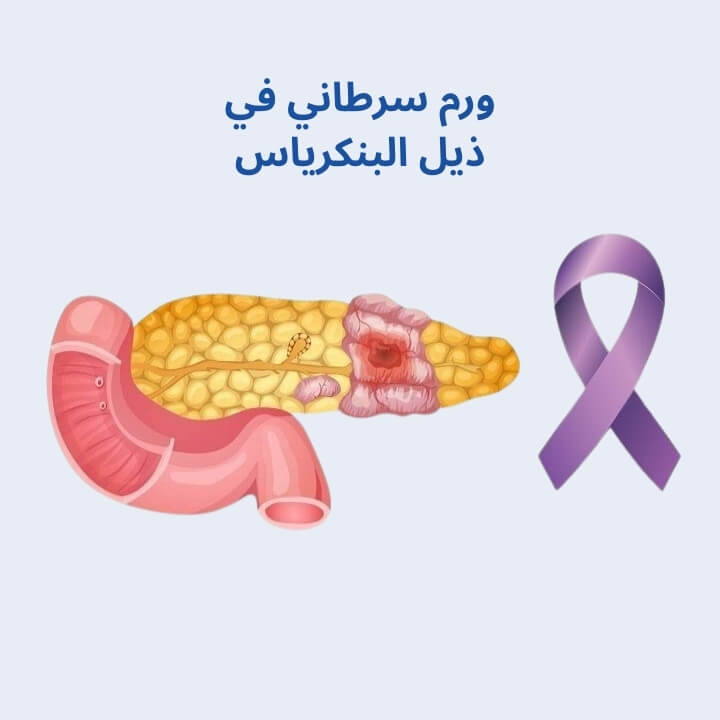 ورم سرطاني في ذيل البنكرياس