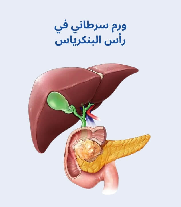 ورم سرطاني في رأس البنكرياس